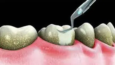 جرم گیری چیست؟