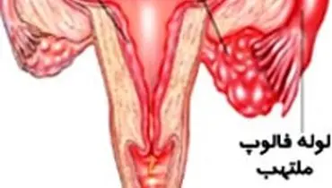 علت التهاب لگن در زنان چیست