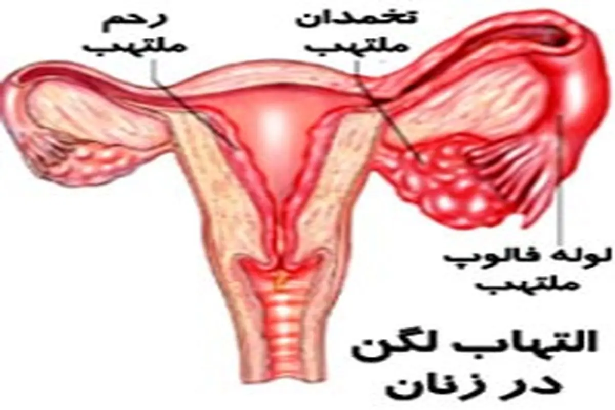 علت التهاب لگن در زنان چیست