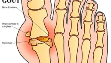 علایم و راه‌های پیشگیری از بیماری نقرس