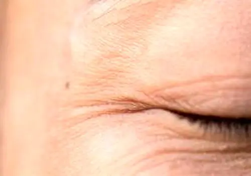  ترانگزامیک اسید چیست؟