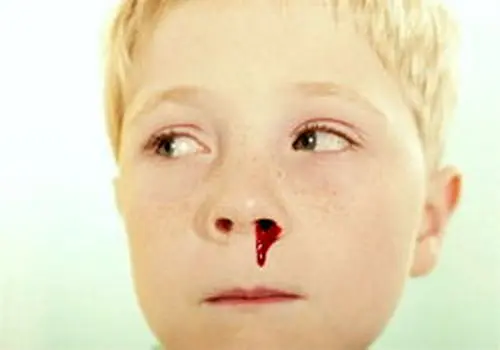 خون دماغ و ترشحات بینی در این شرایط خطرناک هستند
