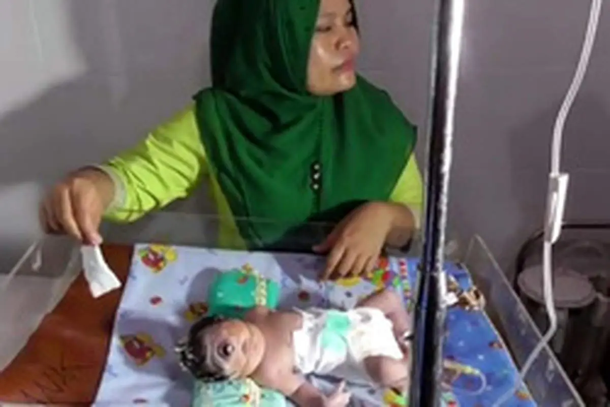 نوزاد تک چشم در اندونزی متولد شد +عکس