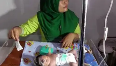 نوزاد تک چشم در اندونزی متولد شد +عکس
