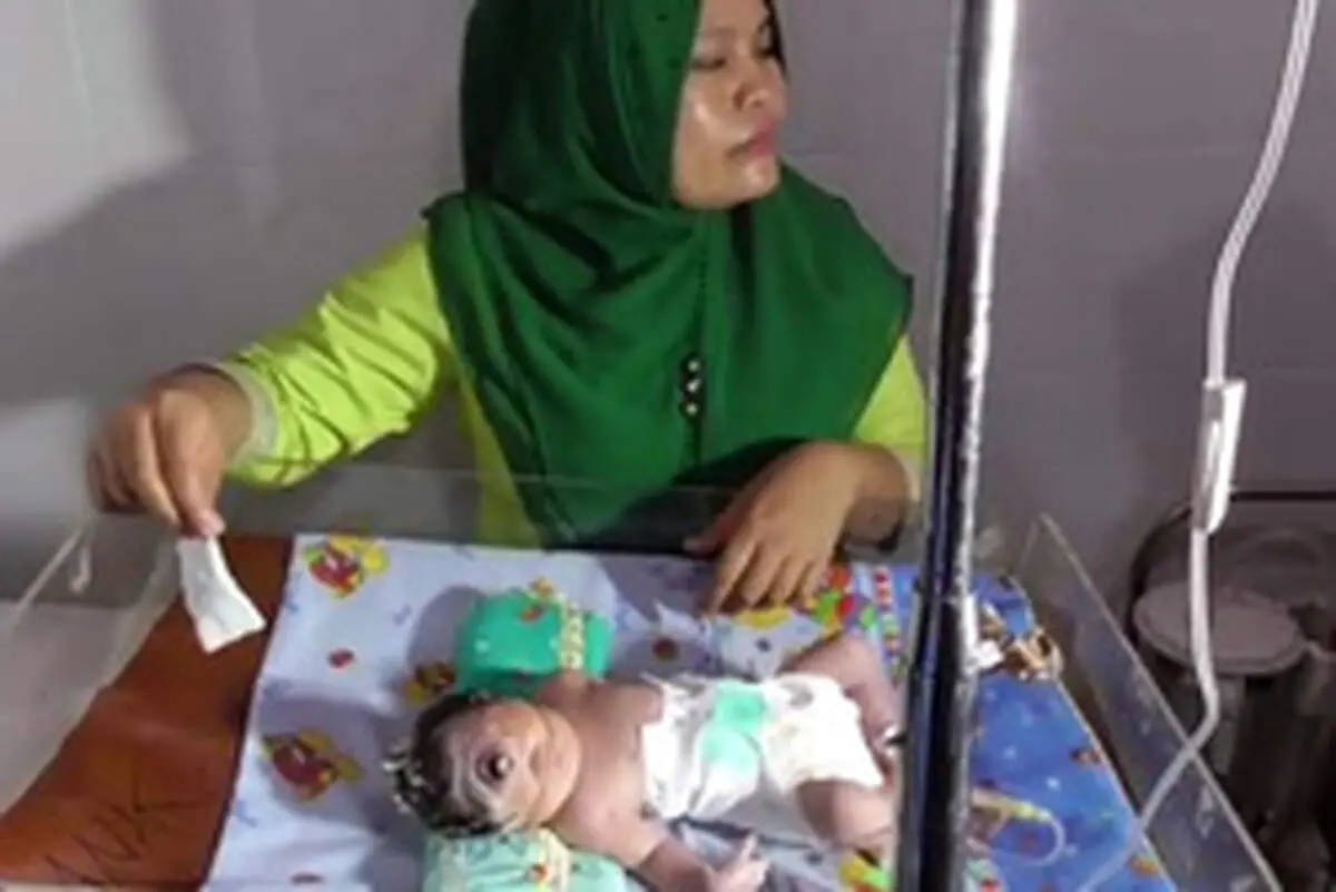 نوزاد تک چشم در اندونزی متولد شد +عکس