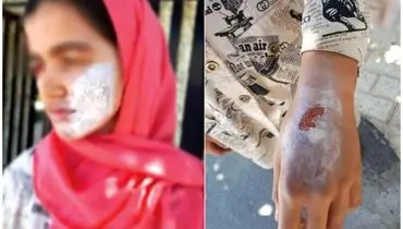 بازداشت نامادری سنگدل که بدن دخترخوانده را می‌سوزاند