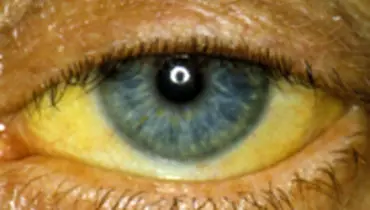 علت زردی چشم ها چیست؟