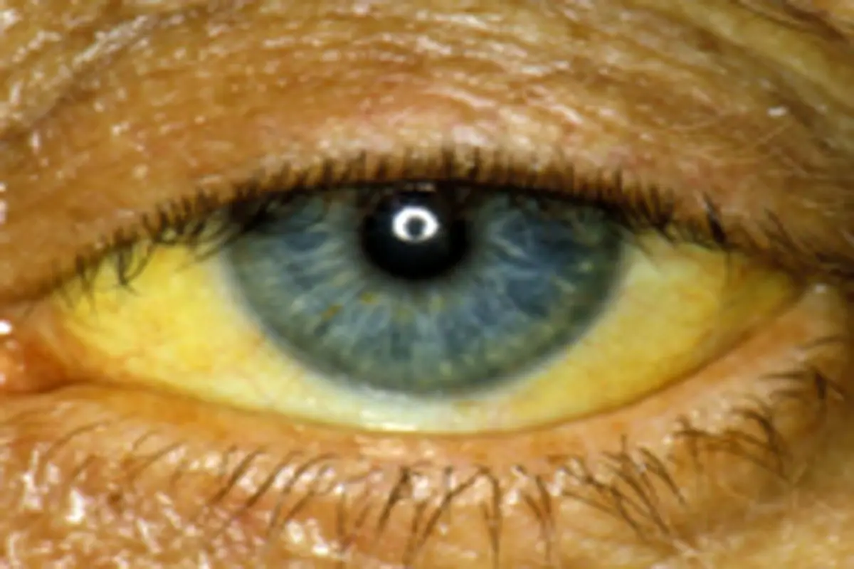 علت زردی چشم ها چیست؟