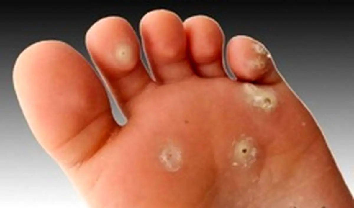 میخچه را چطور درمان کنیم؟