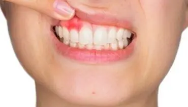 چند راهکار‌ مهم برای درمان خونریزی لثه
