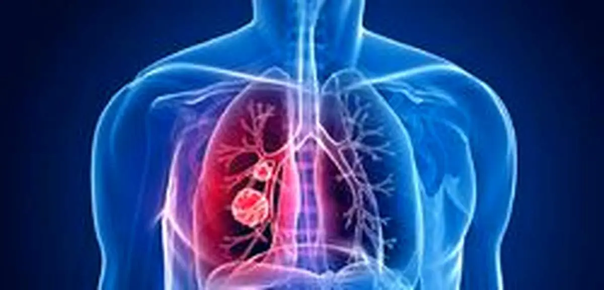 علایم عجیب سرطان ریه