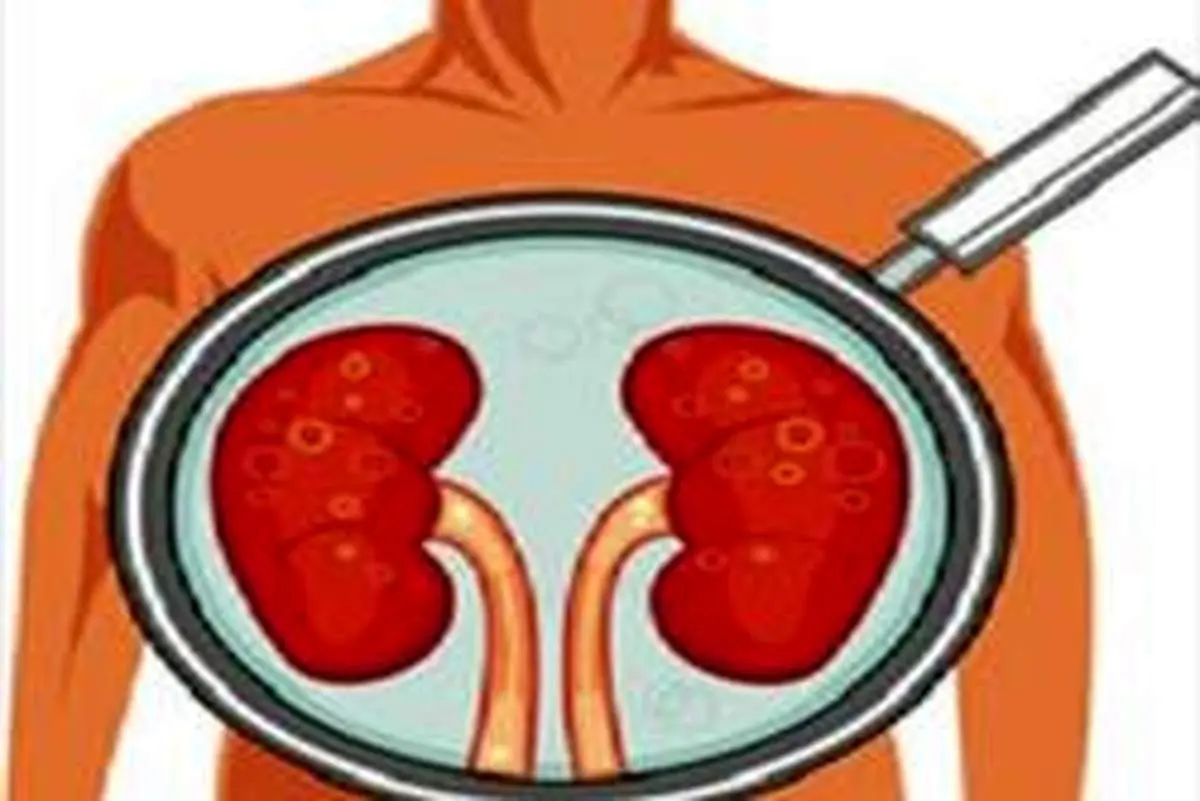 نارسایی کلیه به چه علت بروز پیدا میکند؟
