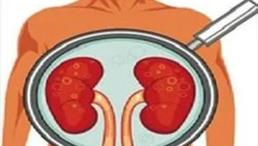 نارسایی کلیه به چه علت بروز پیدا می‌کند؟