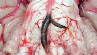 علت سکته مغزی در زنان