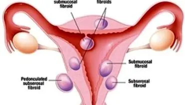 دانستنیهایی درباره فیبروم رحم