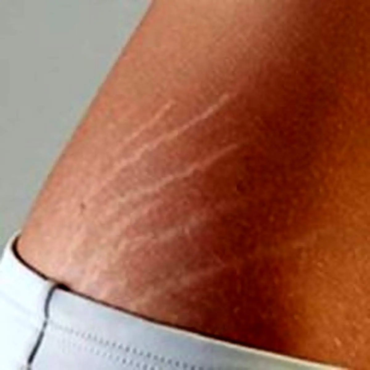 ترک‌های پوستی را نامرئی کنید