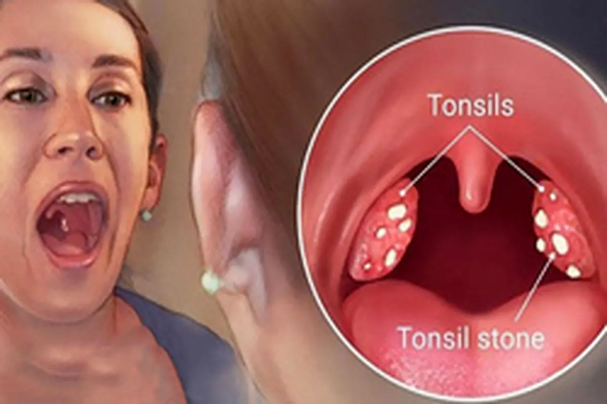 علل، علائم و درمان سنگ لوزه چیست؟