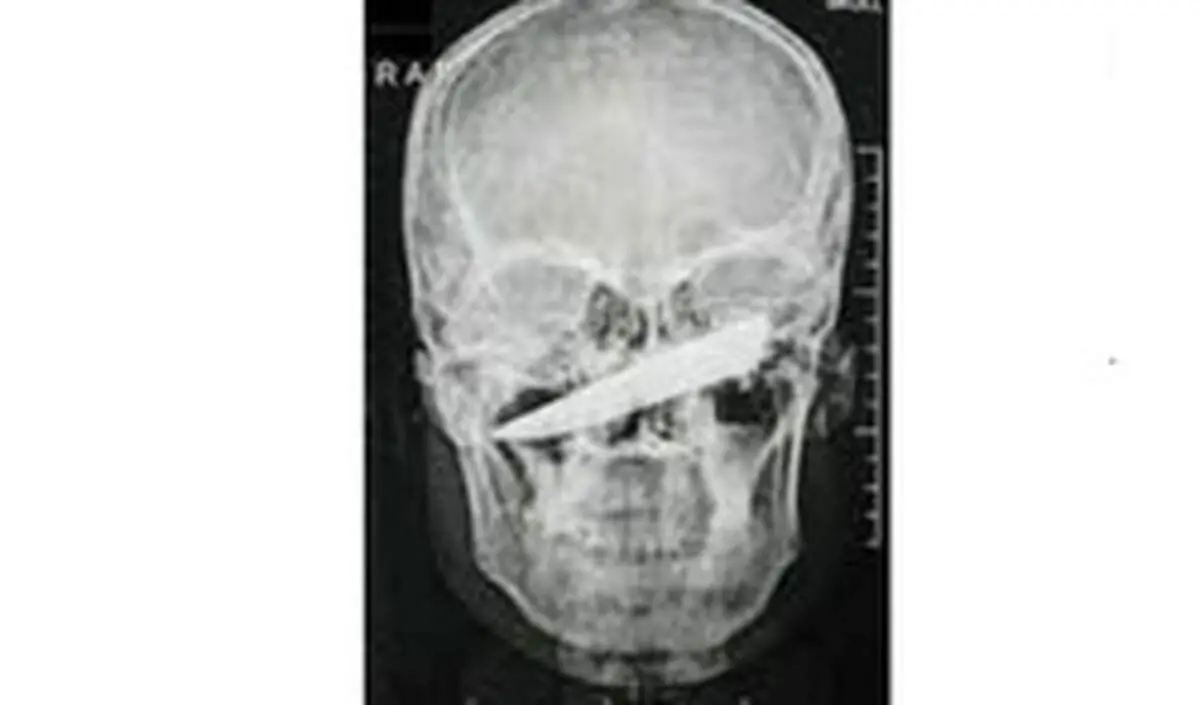 خارج کردن چاقو از صورت یک مرد!