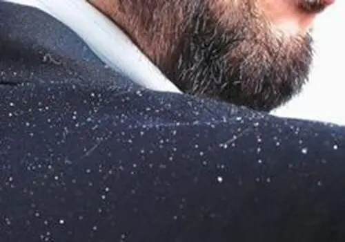 درمان فوری شوره مژه و ابرو