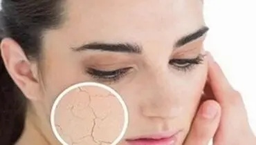 عوارض استرس بر سلامت پوست