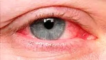 علایم عفونت چشم را بشناسید