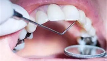 چه موقع دندان عقل را بکشیم؟
