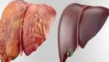 مراقب چربی خون و چاقی باشیم