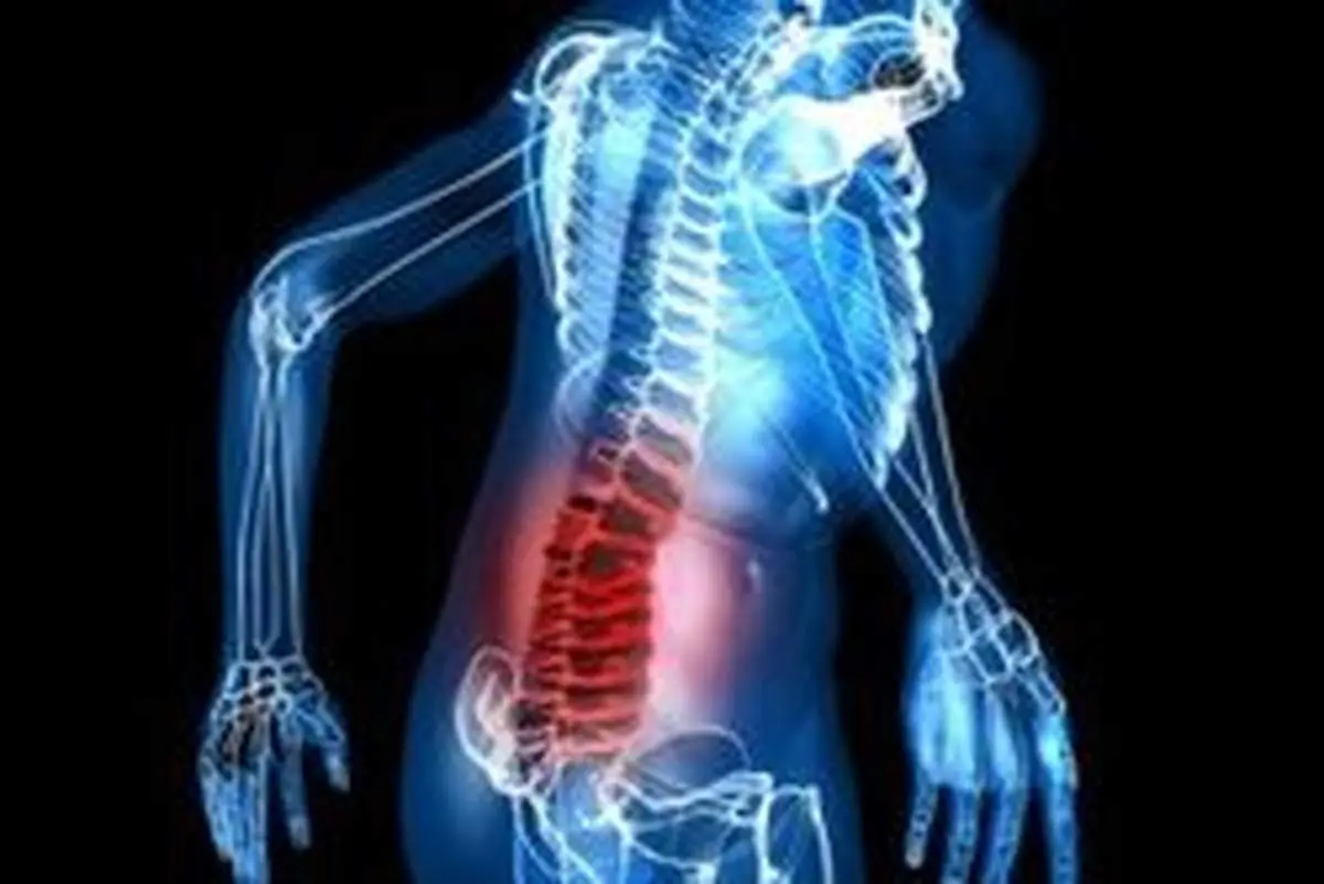 راهی برای پیشگیری از گودی کمر