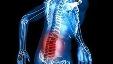 راهی برای پیشگیری از گودی کمر