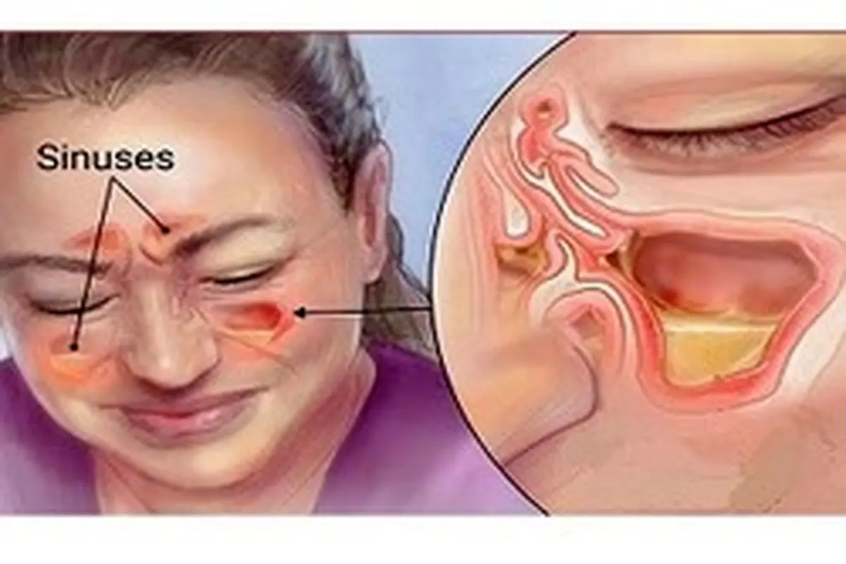سینوزیت و هر آنچه لازم است در مورد آن بدانید