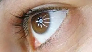تکنیکهای پیشنهادی برای جراحی نزدیک بینی کدامند؟