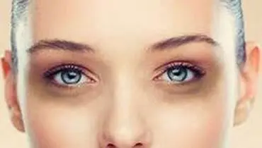 کبودی زیر چشمم را چگونه با آرایش از بین ببرم؟