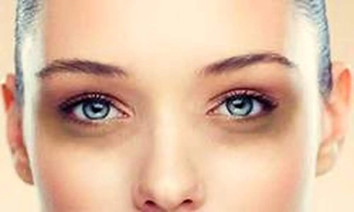 کبودی زیر چشمم را چگونه با آرایش از بین ببرم؟