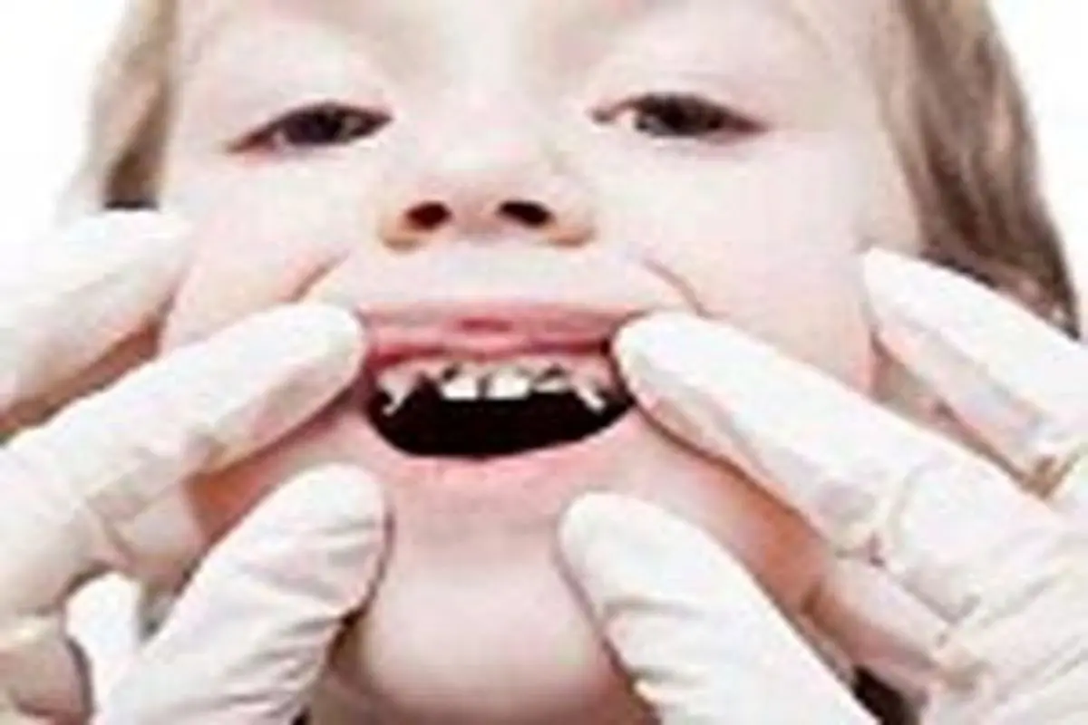 این کودکان به پوسیدگی دندان مبتلا می شوند