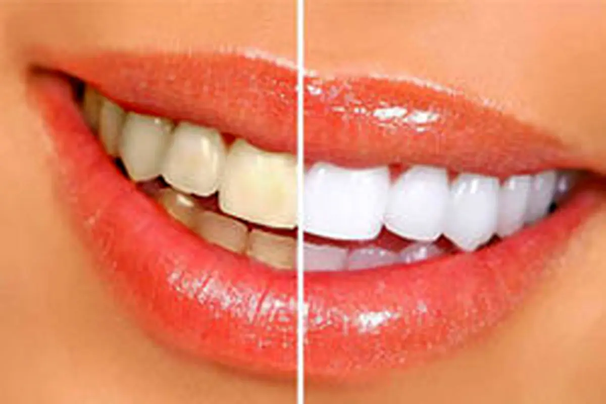 دلیل زرد بودن دندانها چیست؟