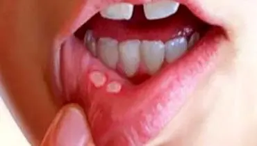 آفت دهان را با داروهای طبیعی از بین ببرید