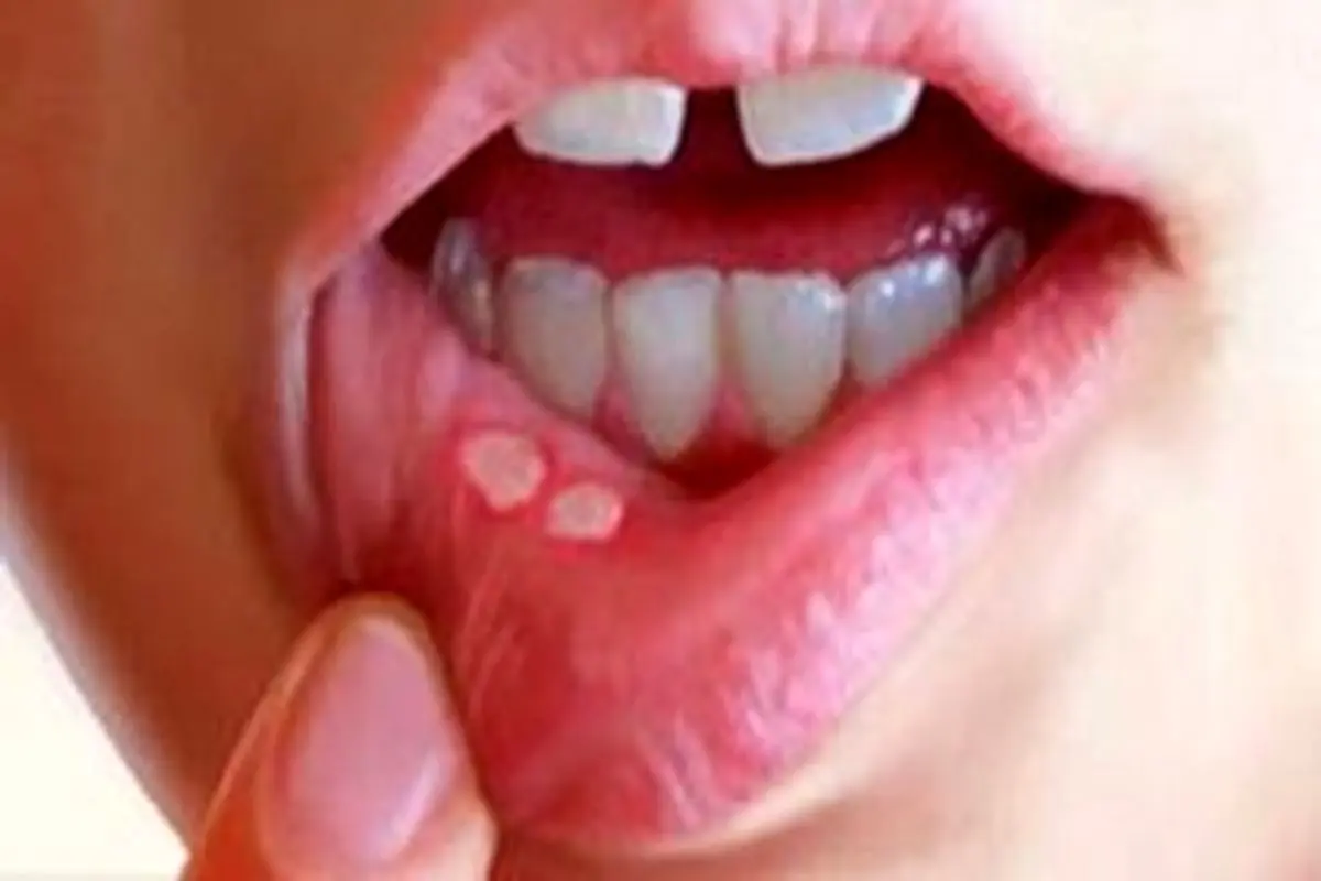 آفت دهان را با داروهای طبیعی از بین ببرید