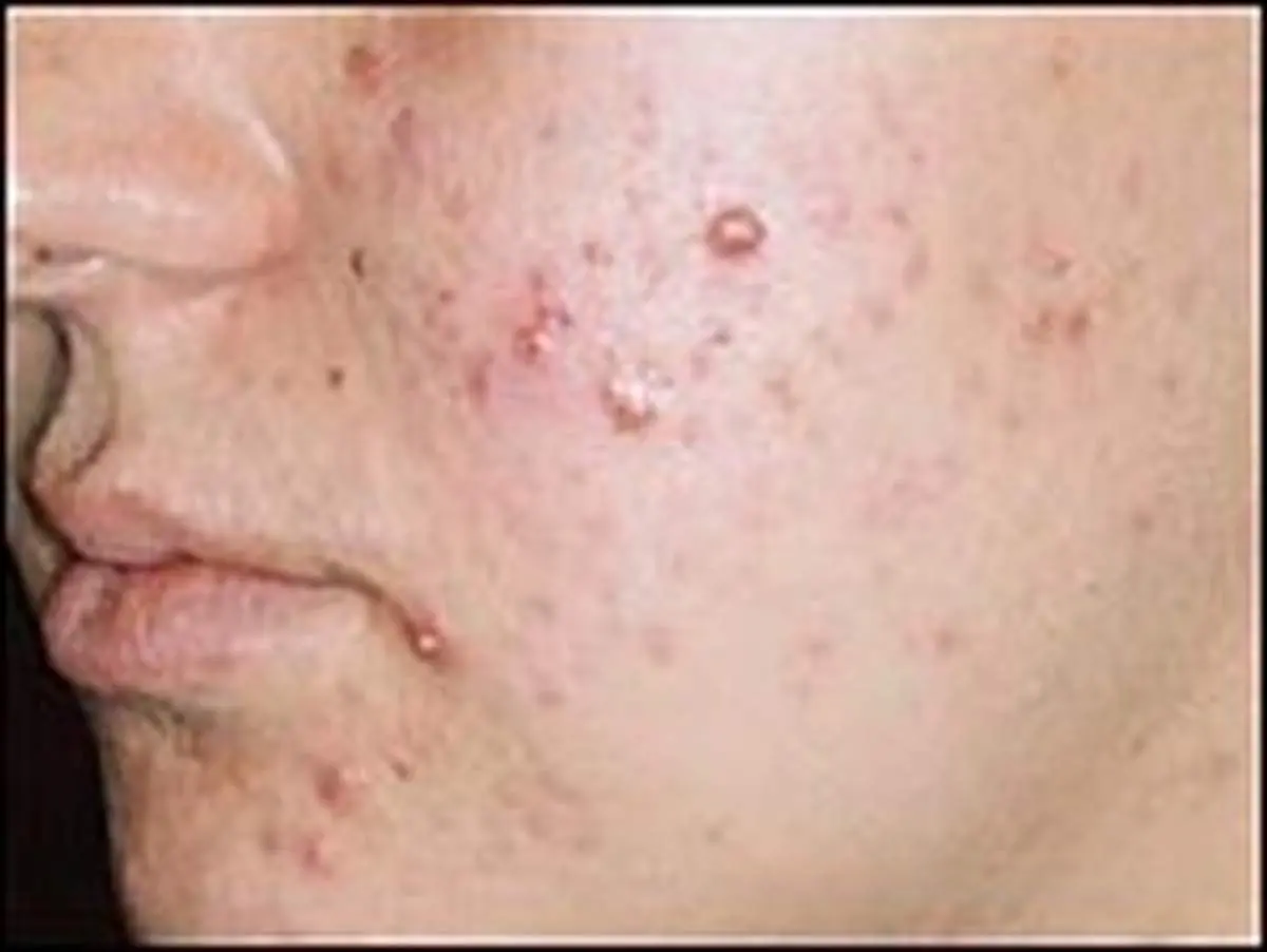 ۱۲ نکته کلیدی برای کاهش جوش‌های صورت