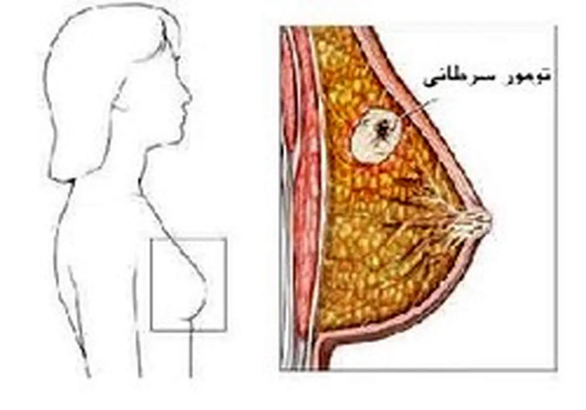 ۵ توصیه غذایی برای پیشگیری از سرطان سینه