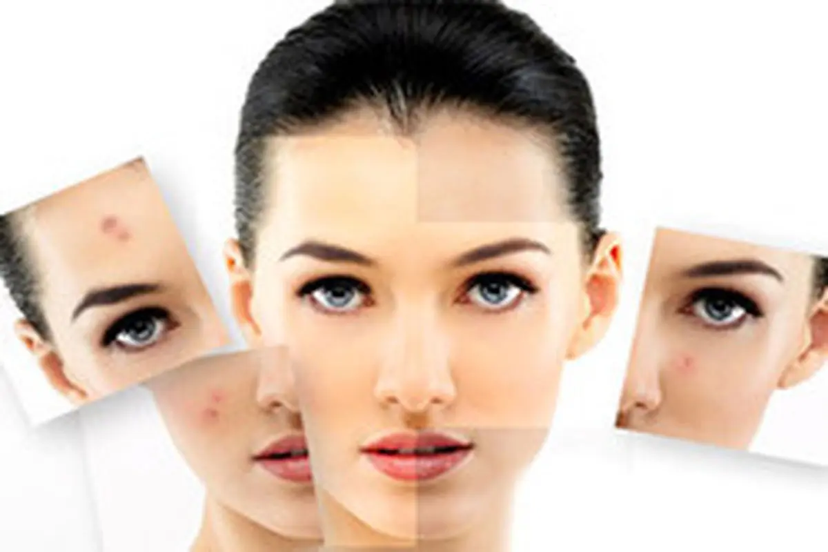 لیزر بهتر است یا پیلینگ؟