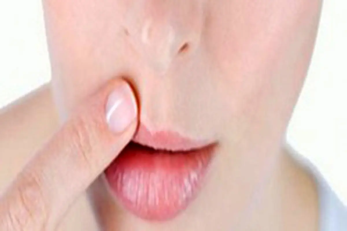 راهکارهای طبیعی و مفید برای رفع تبخال