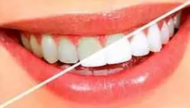 روش سفید کردن دندان‌ها در خانه