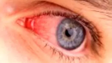 علت قرمزی چشم‌ها چیست؟