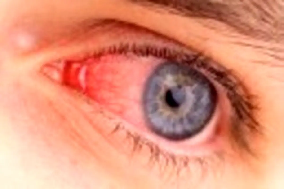 علت قرمزی چشم‌ها چیست؟
