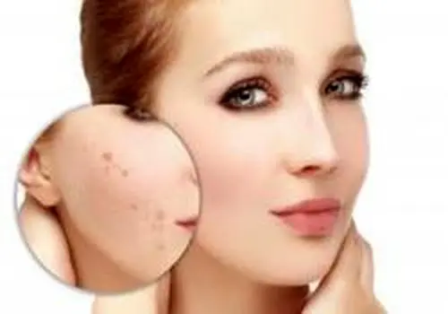 درمان و از بین بردن جوش صورت با روش های موثر