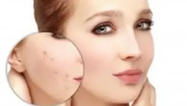 مواد غذایی که باعث جوش صورت می شوند