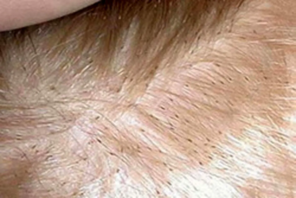 روش هایی برای از بین بردن شپش