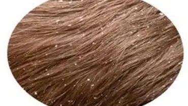 چگونه شوره سر را به روش طبیعی درمان کنیم؟