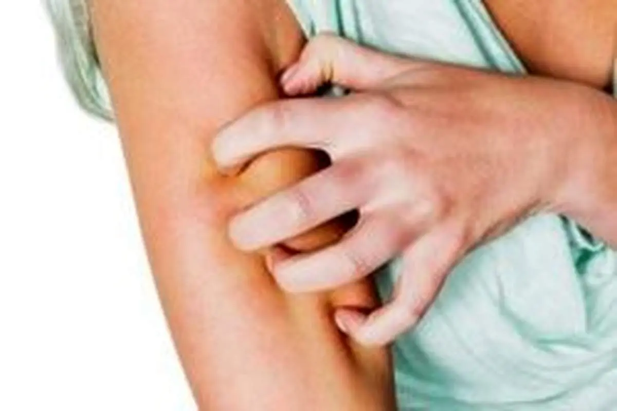 از پوستهای خارش دار چه میدانید؟