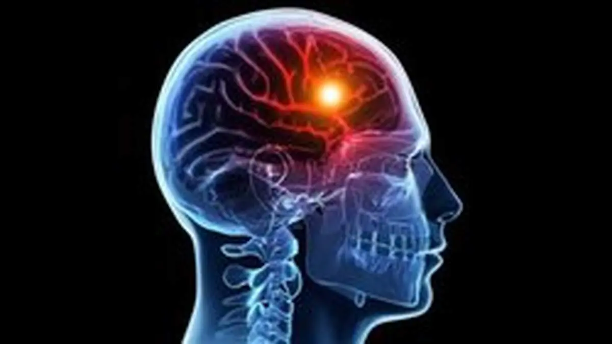 نیمی از سکته‌های مغزی قابل پیشگیری هستند